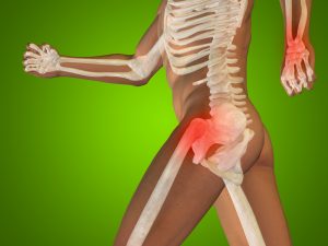 ארטריטיס (Arthritis) היא "דלקת מפרקים" בשפה מקצועית. דלקת המפרקים גורמת לכאב ולנפיחות במפרקים שונים בגוף כמו בברכיים ובירכיים. יש סוגים רבים של דלקות מפרקים, אך השכיחה ביותר היא דלקת מפרקים ניוונית (אוסטאוארטריטיס), המתפתחת עם עליית הגיל.