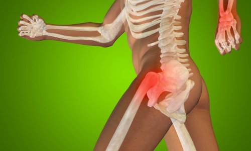 ארטריטיס (Arthritis) היא "דלקת מפרקים" בשפה מקצועית. דלקת המפרקים גורמת לכאב ולנפיחות במפרקים שונים בגוף כמו בברכיים ובירכיים. יש סוגים רבים של דלקות מפרקים, אך השכיחה ביותר היא דלקת מפרקים ניוונית (אוסטאוארטריטיס), המתפתחת עם עליית הגיל.