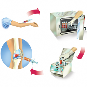 אורטוקין היא טכנולוגיה ביולוגית מתקדמת לטיפול במפרקים עם אוסטאוארטריטיס, פציעות ספורט ופריצת דיסק ללא תופעות לוואי.