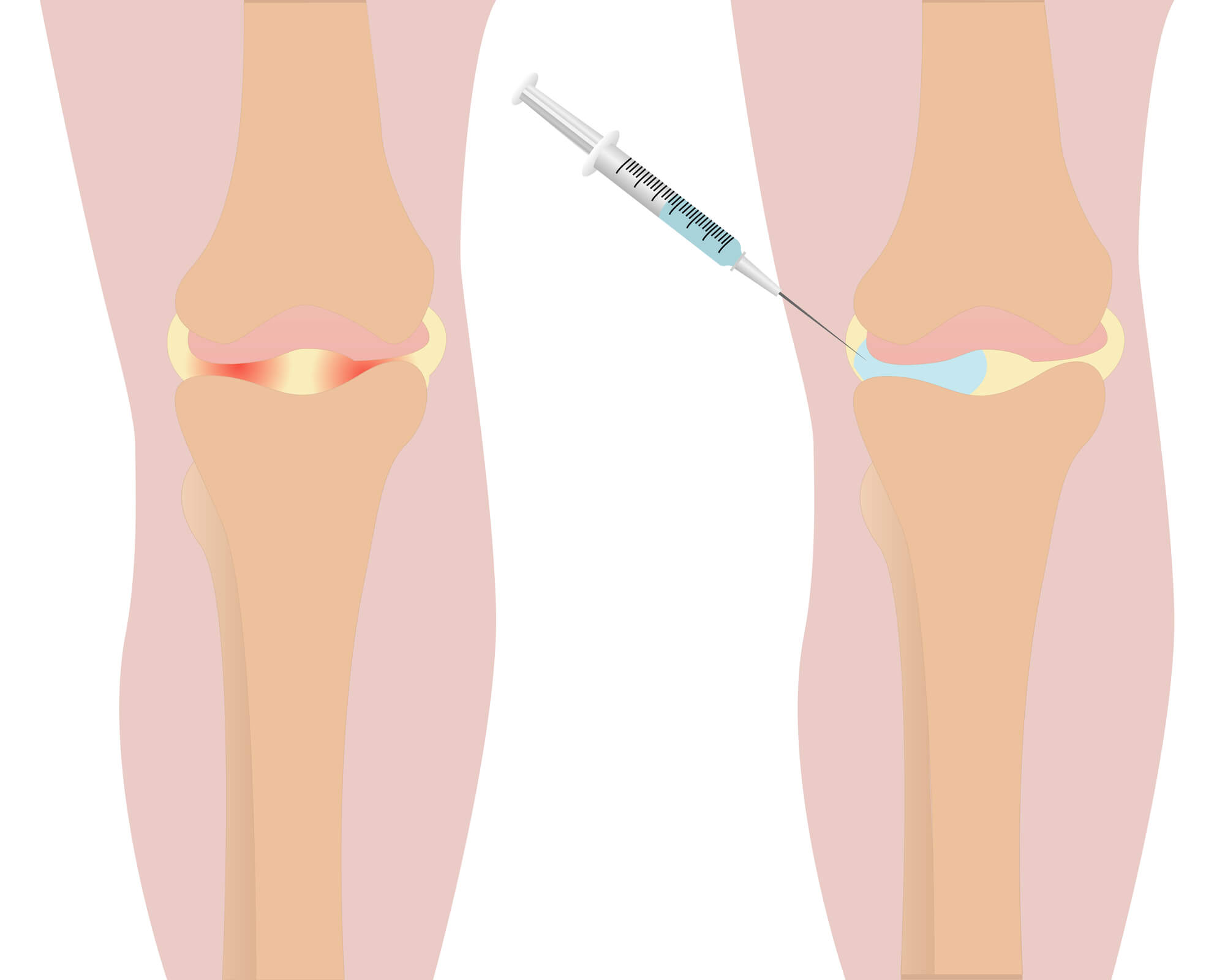 Можно в коленный сустав делать уколы. Инъекция в коленный сустав. Инъекции для суставов коленей.