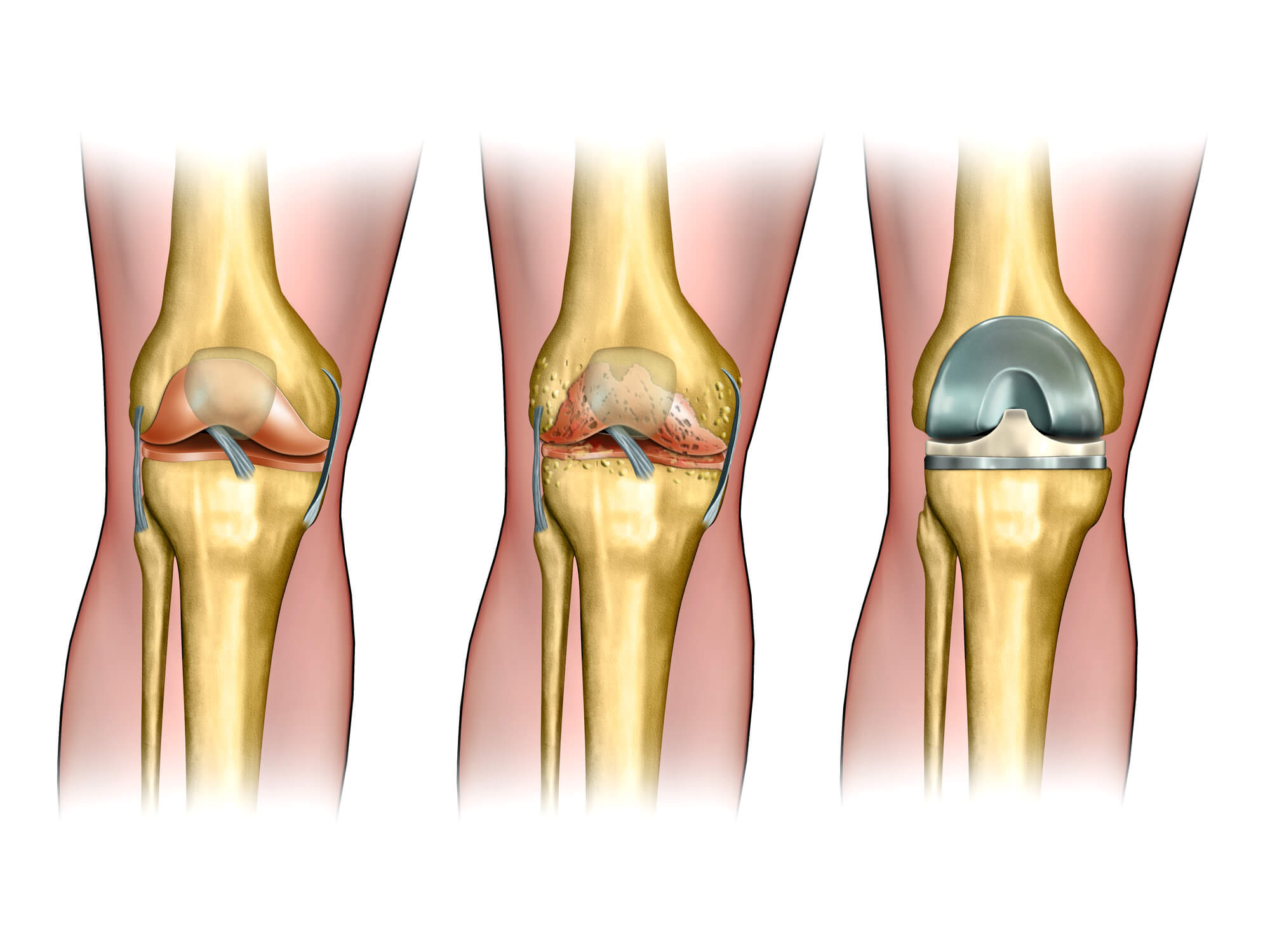 Восстановление сустава без операции. Менископатия коленного сустава. Артроз коленного сустава эндопротез. Ревматоидный артрит коленного сустава. Гонартроз коленного сустава 1.